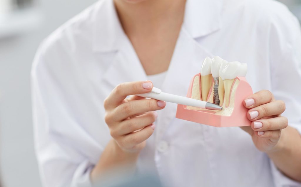 Zahntechnikerin hält ein Zahnimplantat Modell und zeigt mit einem Stift auf den Zahnersatz
